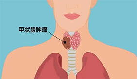 甲状腺结节爱这四类人，做好这些，改善结节！